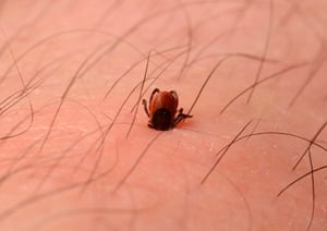 Photograph of a deer tick embedded in skin of a leg.