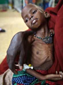 A woman holds her malnourished child