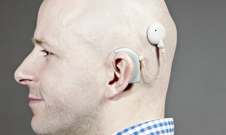 Profile view of a bald man with a cochlear implant attached to his head, showing the external processor and ear piece.