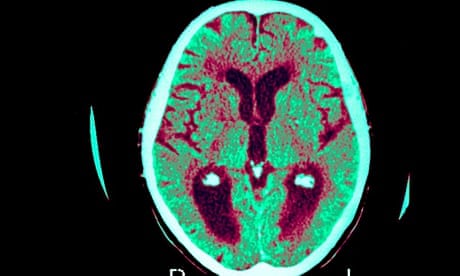 A scan shows the effect of Alzheimer's disease on the human brain