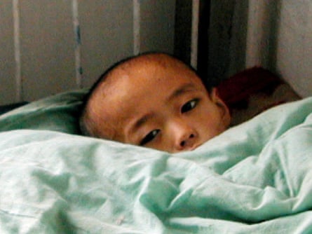 A 14-year-old North Korean boy suffering from malnutrition lies in a bed at Chongjin city peadiatric hospital.