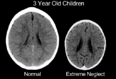  much-used image purporting to show the affect of neglect on children's brain development