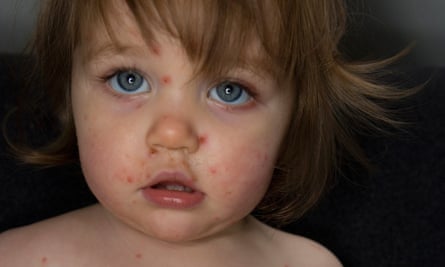 What S The Real Reason Britons Aren T Offered The Chickenpox Vaccine Infectious Diseases The Guardian