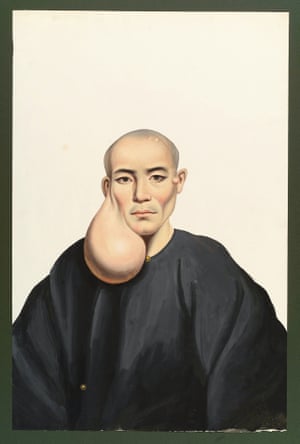 A man with a largependent face tumor. In 1835 the American physician Peter Parker opened a hospital in the Chinese city of Canton. For five years he commissioned gouache paintings from the painter Lam Qua, depicting patients at the hospital.
