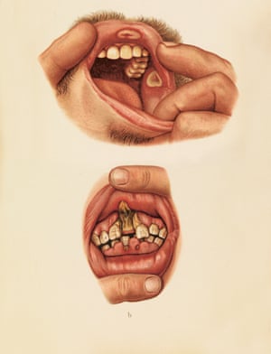 Inflamed erosions, known as diphtheritic papules, in the mouth of a male patient.