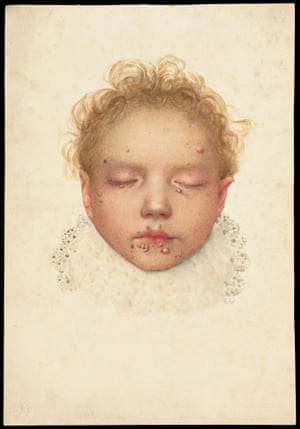 The head of a child with blisters and other lesions affecting the skin.