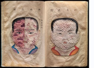 Hand-drawn and textured pages from a rare, possibly unique, Japanese treatise on smallpox - The Essentials of Smallpox (Toshin seiyo) written in the late seventeeth or early eighteenth century by the Japanese doctor Kanda Gensen. These illustrations offer a different way of depicting disease, one that invokes touch as much as sight.