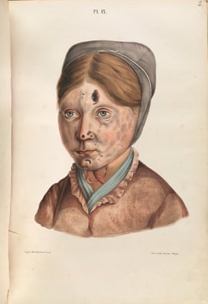 The head of a thirteen year old girl with leprous lesions affecting her face.
