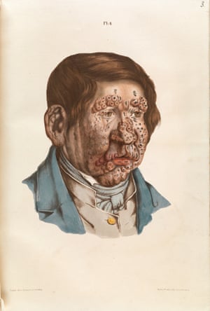 The head of a thirteen year old boy, showing severe untreated leprosy.