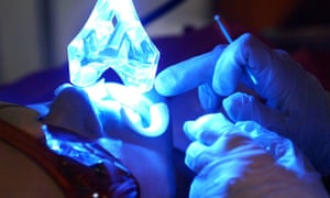 Laser tooth whitening is now common