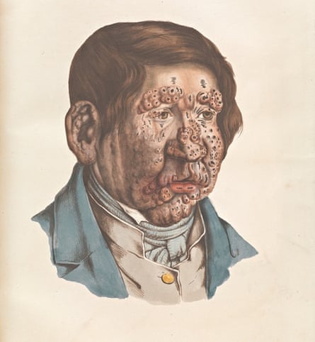 Leprosy: an historical illness scientists can not remedy
