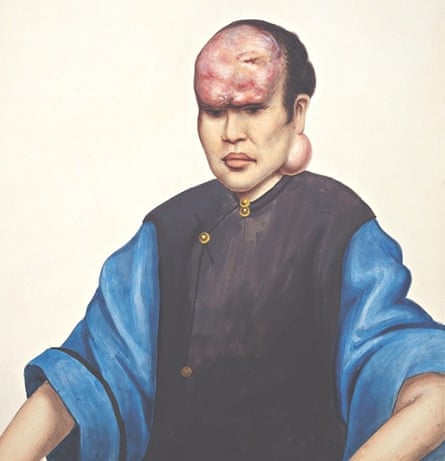 The Sick Rose A woman (Le Sanying) with tumours on her