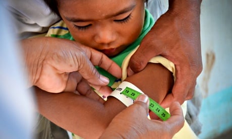 Child in the Phillippines being measured for malnutrition