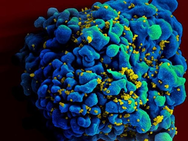 An H9 T cell, blue, infected with the human immunodeficiency virus (HIV), yellow.