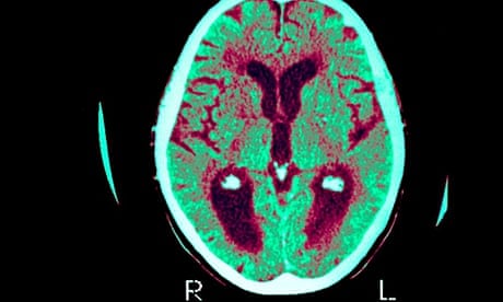 Alzheimer's disease brain scan