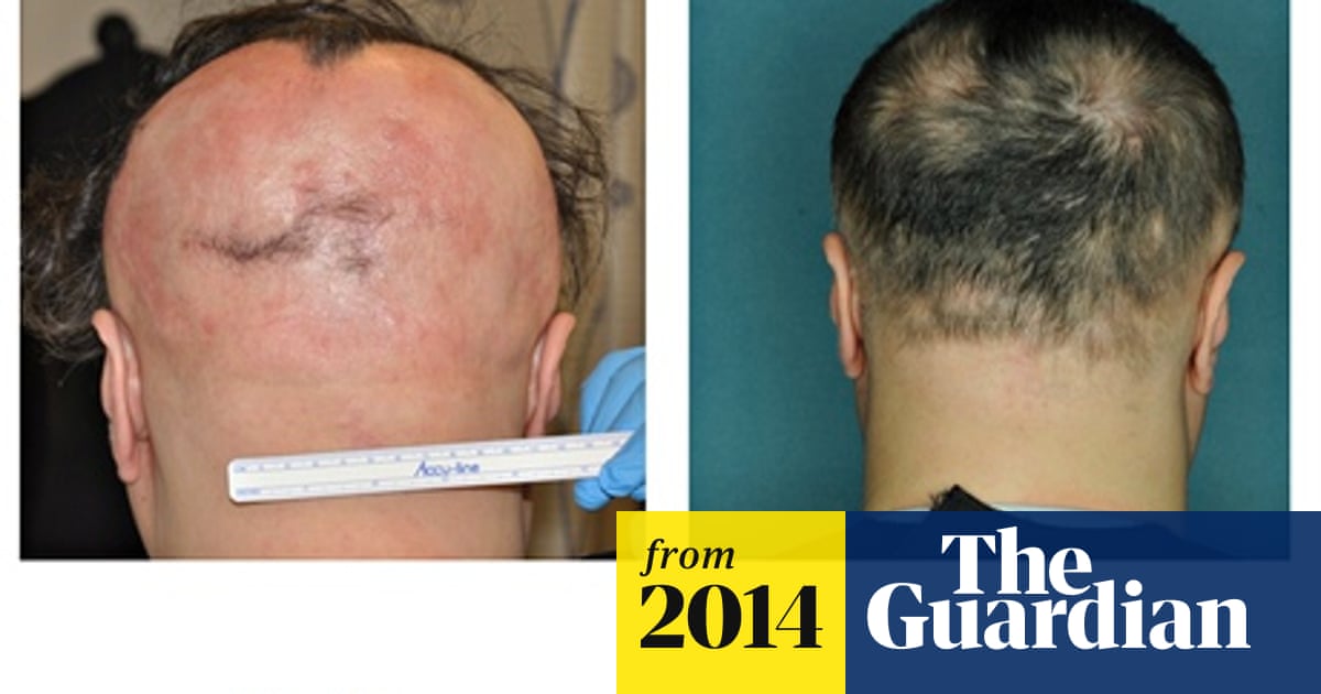 Alopecia Sufferers Given New Treatment Hope With Repurposed Drug