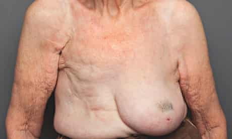 This 52 year-old with H cup breasts complained of neck and back