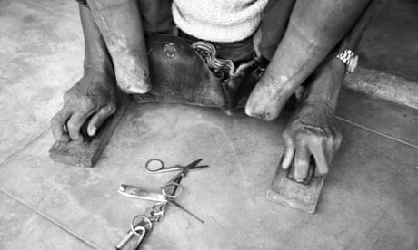 People Affected By Leprosy In India Face Stigma Reinforced By Cruel Colonial Law Global Development The Guardian