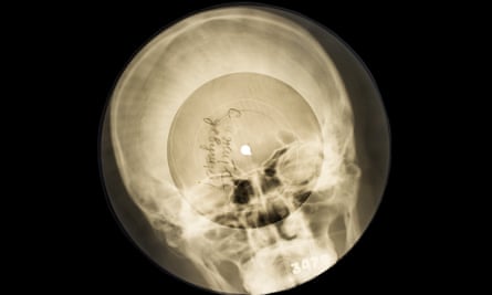 A skull x-ray recording.