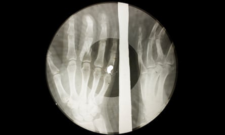 A hands x-ray recording.