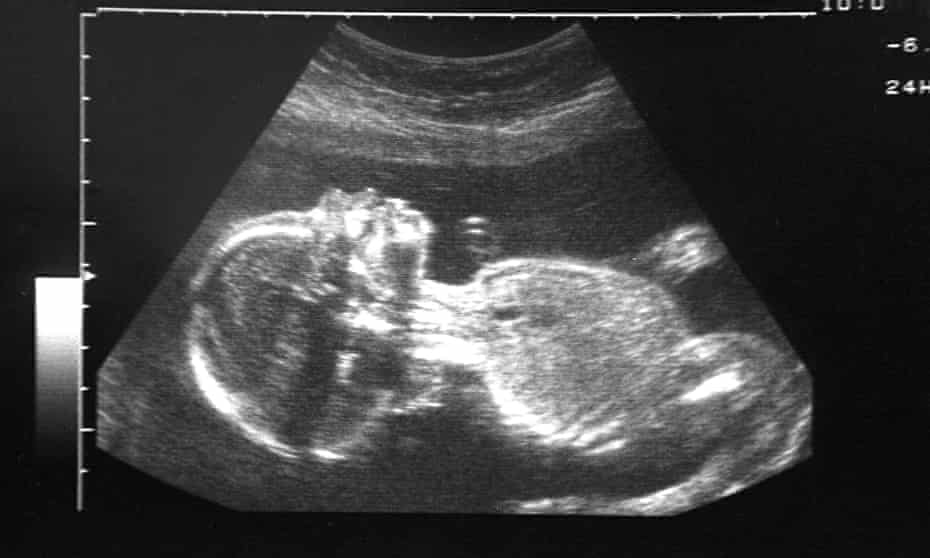 Twenty week ultrasound scan of a healthy foetus