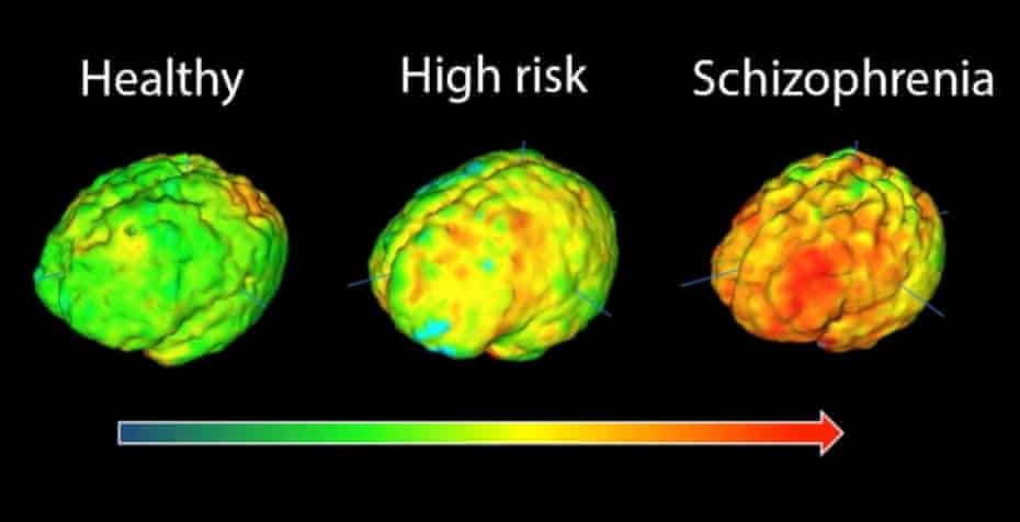 Hyper cortex: why does my brain mac osteoarthritis Hyper cortex: why does my brain mac osteoarthritis
