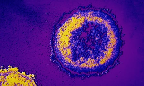 The HIV virus under a microscope.