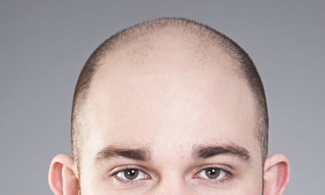 Going, going, gone: I started losing my hair at 16 | Men's hair | The  Guardian