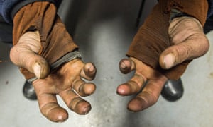 Musher Lance Mackey shows his hands at the Tanana, Alaska checkpoint. Mackey suffers from poor circulation in his hands and feet and is using battery-powered gloves in this year's Iditarod race
