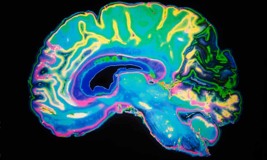 Scan of human brain with dementia. Researchers say preliminary findings suggest treatments targeting amyloid will need to be given early in the disease.