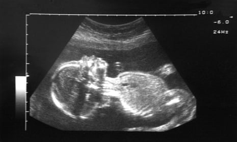 Ultrasound female embryo