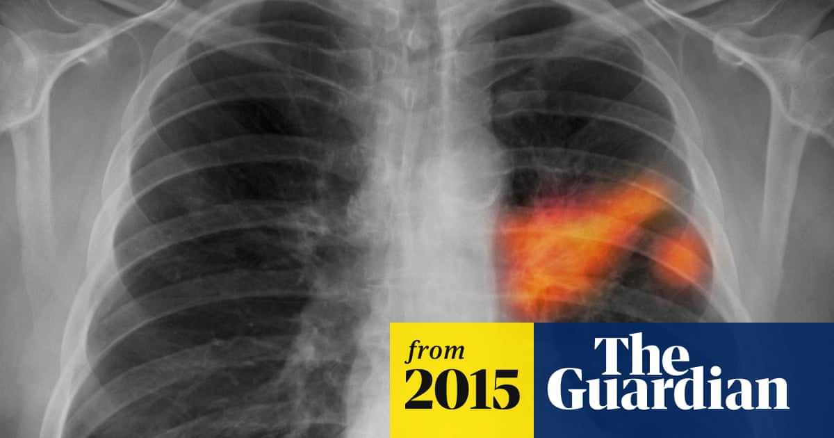 Lung Cancer Stem Cell Therapy To Be Trialled In Uk Cancer Research The Guardian
