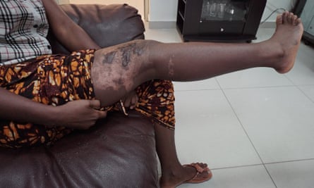 Adama, 24, a domestic worker from Sierra Leone, shows the scars on her leg. She says they were caused when her Kuwaiti employer deliberately spilled hot oil on her.