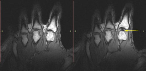 Images of the knuckles before (left) and after cracking (right).