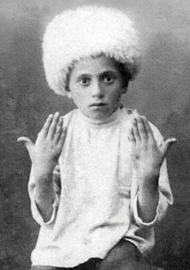 A 10 year-old Armenian orphan named Mushegh displays wounds.