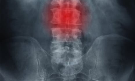 X-rays for back pain may be more difficult to obtain under the new approach.