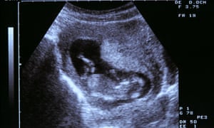 for paracetamol week old baby 2 Paracetamol pregnancy harm may study foetus, in use male for paracetamol week old baby 2 Paracetamol pregnancy harm may study foetus, in use male