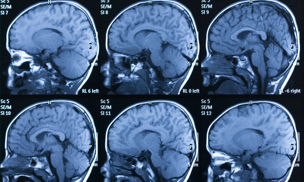 Brain scans of premature babies reveal changes that may Brain scans of premature babies reveal changes that may
