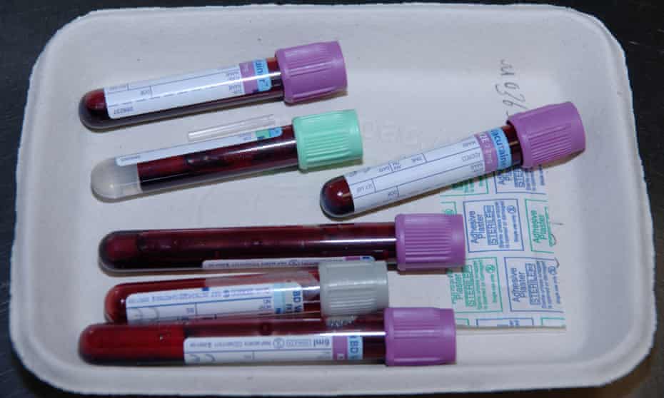 The new blood test examines variations in the level of a protein called CA125, which is linked to ovarian cancer.