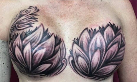 Look How Beautifully Tattoo Artists Cover The Surgery Marks Of