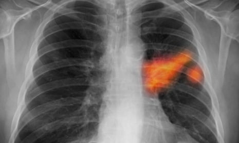 An X-ray showing cancer in a smoker’s lung. Unexplained fatigue in someone over 40 who has ever smoked merits a chest X-ray for lung cancer, according to the new guidance.