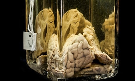 A 'wet' specimen from the Mütter Museum in Philadelphia