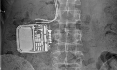Beyond paracetamol … an x-ray showing the neurostimulator embedded in Sander Pleji's back.