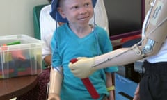 Baraka Lusamb, 5, learns to use a prosthetic limb at Shriners Hospital for Children in Philadelphia