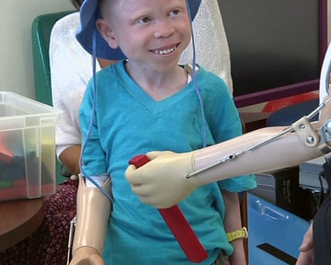 Baraka Lusamb, 5, learns to use a prosthetic limb at Shriners Hospital for Children in Philadelphia