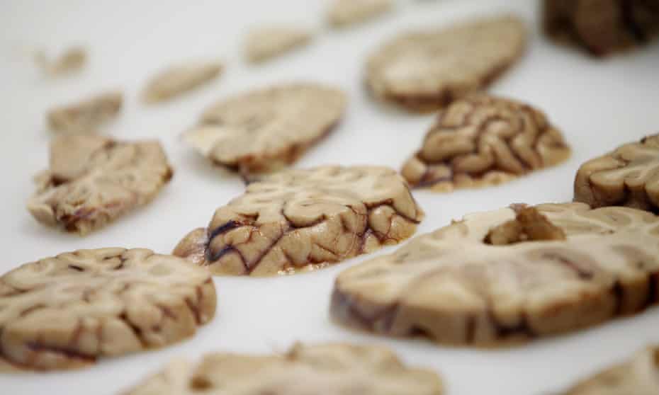 A human brain being dissected for research purposes at the Parkinson's U.K. Brain Bank.
