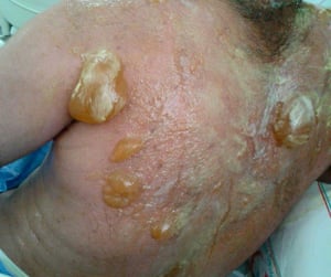 Blisters on a victim of the mustard gas attack.