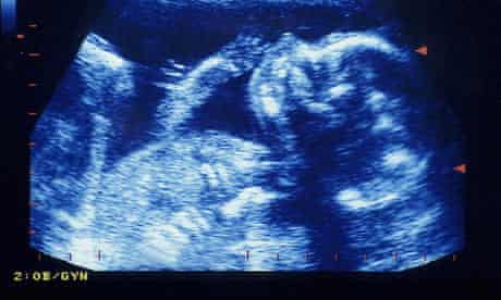 Human Foetus Feels No Pain Before 24 Weeks Study Says Pregnancy The Guardian Human Foetus Feels No Pain Before 24 Weeks Study Says Pregnancy The Guardian