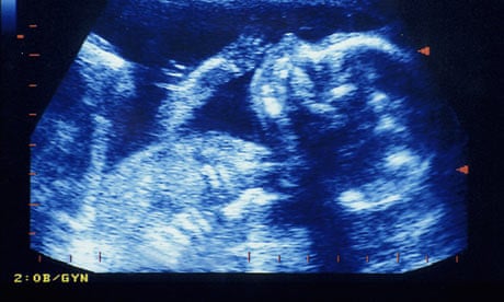 Ultrasound scan of foetus at 20 weeks