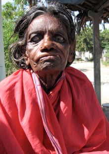 Leprosy sometimes causes nerve damage in the face